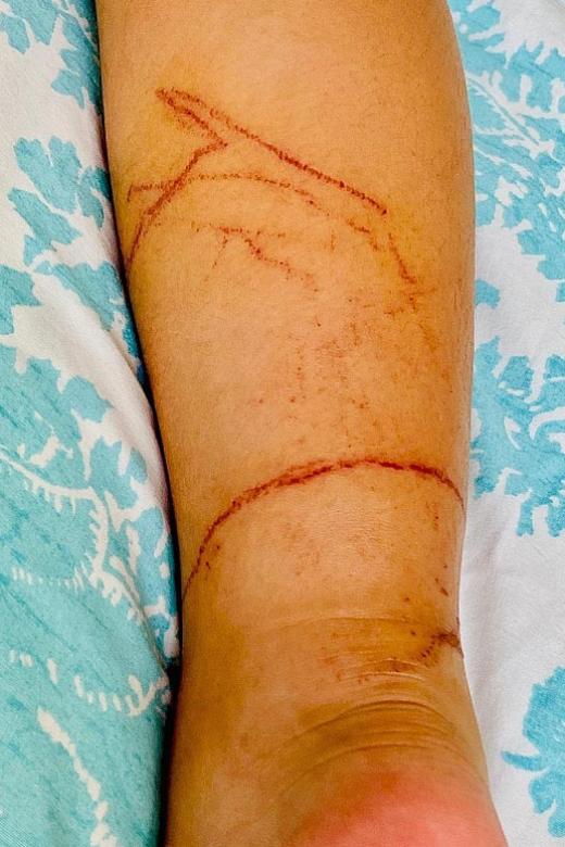 Savvy mum doused girl’s jellyfish injuries with vinegar  