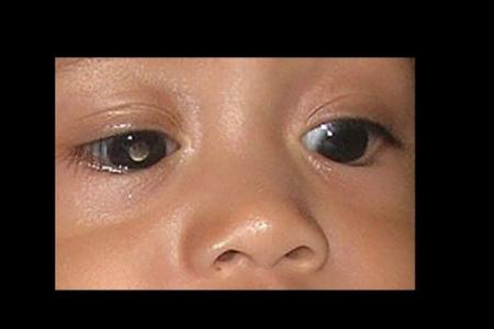 Parents to give up an eye each for their baby 