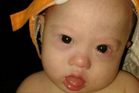 Down Syndrome baby abandoned, surrogate mum has no money to treat him
