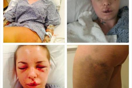 Porn star suffers ruptured liver after MMA fighter ex-boyfriend assaults her