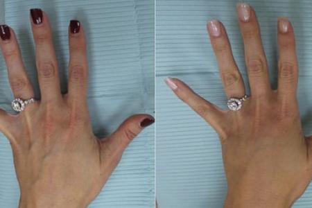 She had hand surgery to make engagement ring looked better