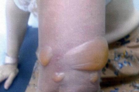 Spa treatment 'shrank' my arm and burned me