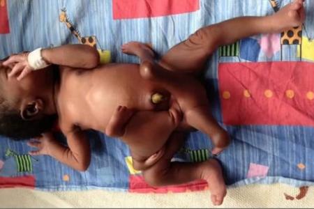 Baby born with 8 limbs recovering well after surgery
