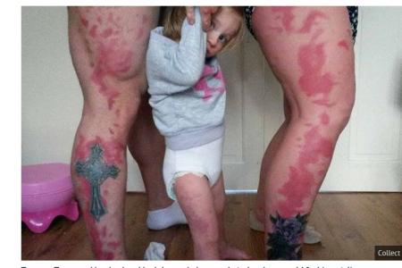 Loving parents get tattoo of daughter's birthmark so she won't feel alone