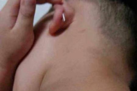 Kindergarten teacher staples boy's ear