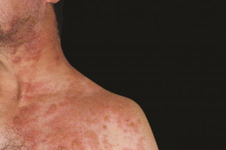 Man suffers 3-year pain from shingles
