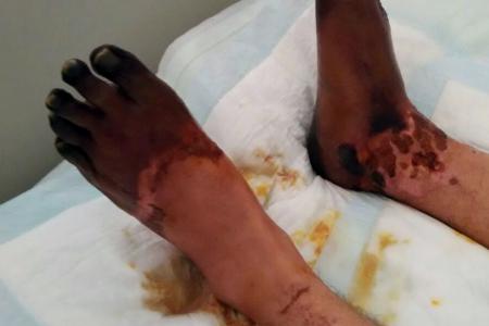 Man's shock: From food poisoning to losing his hands and feet