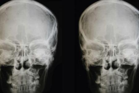 First human head transplant could happen in two years