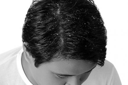 When dandruff means more than an itchy scalp