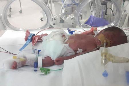 Parents of twins with rare condition: We can’t hold our babies