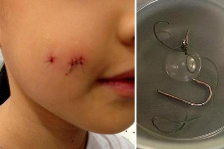  Ms Michelle Tew&#039;s daughter needed four stitches after her right cheek was snagged by a fish hook