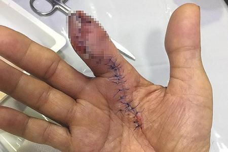 Man has part of finger amputated after being pricked by prawn