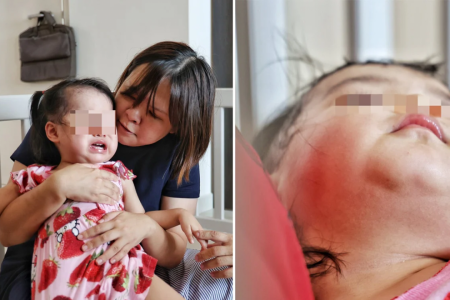 Parents find mysterious bruises on toddler, lodges police report against Aljunied pre-school