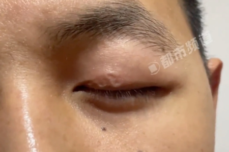 Man with parasites under eyelid says doctors can't treat him, turns to Internet for advice