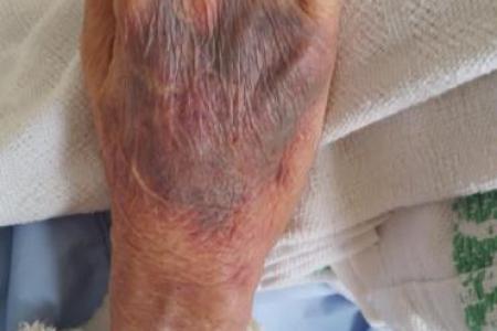 SGH apologises, explains bruising on elderly man's hand