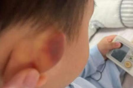 Parents worried after toddler returns home from Yishun pre-school with bruise on ear