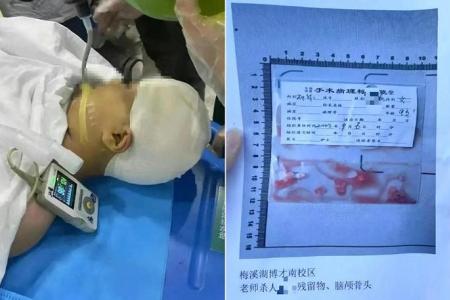 Teacher in China hits school girl, 9, in head with set square; 5-hour surgery to mend cracked skull
