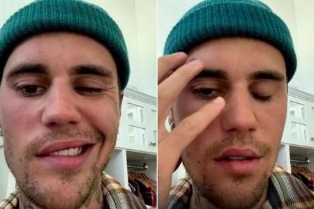 Justin Bieber is showing early signs of recovery, says specialist