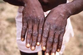 Monkeypox's clades have been particularly controversial because they are named after African regions.