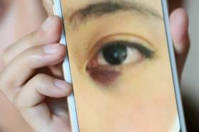 HURT: Jenny, a student from China, showing a bruised eye she claims she got when she was attacked by four classmates in a Balestier condominium unit. 