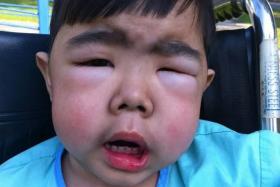 ROAD TO RECOVERY: When Hazrie Alisman Norahman was a toddler, he was so swollen from water retention that his eyes narrowed to slits and it hurt him to be picked up.