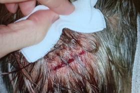 Woman given stitches after hitting head at coffeeshop table