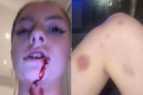 Girlfriend of Man United's Mason Greenwood shares pix of injuries she blames on him