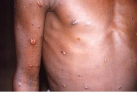 Monkeypox kills up to 10% of those infected, smallpox vaccine may stop it