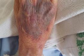 A photo of the bruising on Ms Tan&#039;s father.