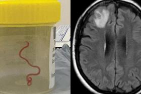 The 8cm Ophidascaris robertsi roundworm was pulled from the patient, still alive and wriggling after brain surgery.