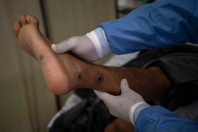 A doctor checks on a patient with sores caused by monkeypox at the Arzobispo Loayza hospital in Lima on Aug 16, 2022.