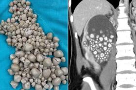 More than 300 kidney stones that looked like “small steamed buns” were removed through minimally invasive surgery.